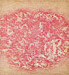 Psoriasis