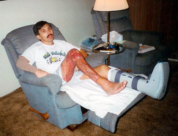 Now-retired Chief Warrant Officer 4 Dan Laguna recovers from his helicopter crash at home in 1995 after months in the hospital. His legs were so damaged, he had to learn a new way to walk by using his toes.