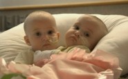 Formerly Conjoined Twins Doing Well After Separation