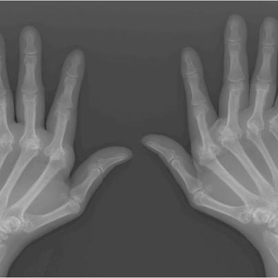 Photo: About 1.5 million people in the US suffer from rheumatoid arthritis (RA). It is a chronic illness in which the immune system, which protects us from viral and bacterial invaders, turns on our own body and viciously attacks the membranes that line our joints. The consequences can be excruciating: pain, swelling, stiffness, and decreased mobility.  Over time, the joints can become permanently contorted, as in this X-ray image.

Learn More: http://directorsblog.nih.gov/nih-research-leads-to-new-rheumatoid-arthritis-drug/