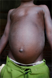 Eggs from the parasite can cause liver damage, which can result in swelling of the abdomen, as seen here in this young boy in Uganda.