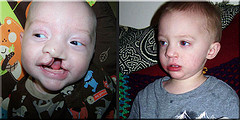 Birth Defects and Down Syndrome: Family Stories