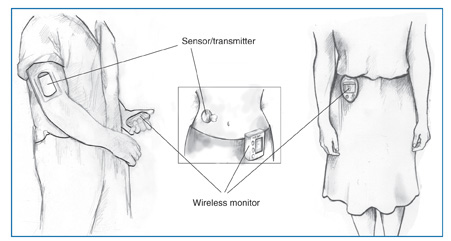 Drawing of three people, each using a different type of wireless continuous glucose monitoring system. A man on the left wears a glucose sensor/transmitter on his right arm and holds a monitor in his left hand. In the middle drawing, a woman's torso is shown with a sensor/transmitter attached to her abdomen and a monitor attached to her clothing. A woman on the right wears a third type of monitor outside her clothing; the sensor/transmitter is worn beneath her clothing so it is not pictured.