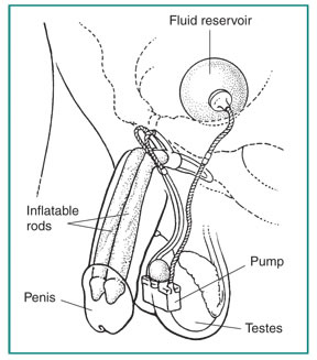 Drawing of an inflatable penile implant to treat erectile dysfunction. An erection is produced by squeezing a small pump implanted in the scrotum. The pump causes fluid to flow from a reservoir in the lower pelvis to two inflatable rods in the penis. The rods expand to create the erection. Labels point to the fluid reservoir, inflatable rods, penis, pump, and testes.