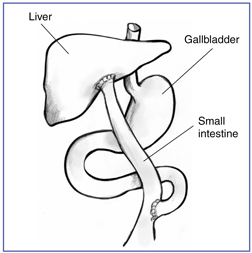 Diagram of the Kasai procedure with liver, gallbladder, and small intestine labeled.