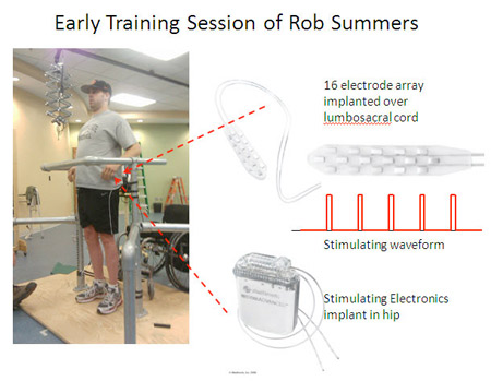 The locomotor training involves being supported over a treadmill, either in a harness or by hand rails, while a team of physical therapists work with his legs to help him stand and step on the machine. During epidural stimulation, electrical pulses are delivered to the surface of his spinal cord, below the injury.