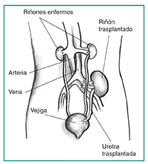 Diagrama anatómico de una silueta femenina con un riñón trasplantado. Los dos riñones enfermos se encuentran todavía en su lugar a cada lado de la columna, debajo de las costillas. El riñón trasplantado se encuentra del lado izquierdo, justo encima de la vejiga. Un uréter trasplantado conecta al riñón nuevo con la vejiga. Las etiquetas señalan hacia los riñones enfermos, la arteria, la vena, el riñón trasplantado, la uretra trasplantada y la vejiga. 