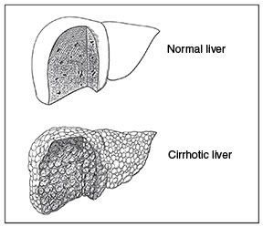 Drawings of a normal and a cirrhotic liver. The drawing on the top shows a cross section of normal liver tissue. The drawing on the bottom shows a cross section of cirrhotic liver tissue.