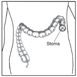 Drawing of the large intestine with the diseased segment removed and a stoma placed at the end. 