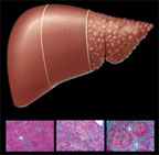 2002 NIH Consensus Conference on Management of Hepatitis C thumbnail image
