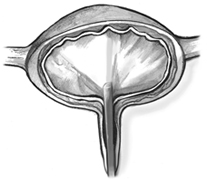 Cross-section diagram of a bladder with cystoscope visible in the urethra.