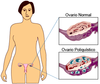 ovario normal - ovario poliquistico