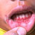 thumbnail image of Herpes simplex