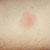 thumbnail image of Tuberculosis: delayed hypersensitivity skin test