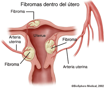 Fibromas dentro del útero; fibroma; arteria uterina; sibroma; fibroma; arteria uterina