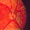 Fundus photo showing focal laser surgery for diabetic retinopathy.
