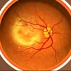 Very advanced age-related macular degeneration.