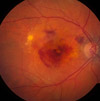 A fundus photo showing neovascular age-related macular degeneration.