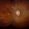 Retina photo of a patient with Leber congenital amaurosis (LCA)