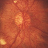 Proliferative retinopathy