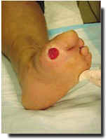 Plantar ulceration image.