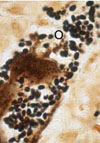  Tubulinosema sp. Microsporidian Myositis in Immunosuppressed Patient