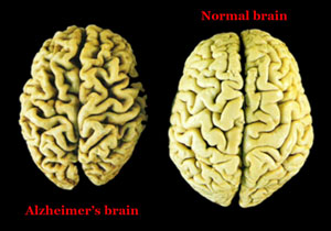 Brain affected by Alzheimer's Disease (left) vs Normal Brain (right) - (Image: US Dept of Veterans Affairs)