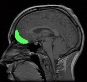 Researchers are suggesting that the brain’s orbitofrontal cortex (highlighted in this MRI image) may play a key role in influencing food choices.  (MRI Image: Paul Wicks via Wikimedia Commons)