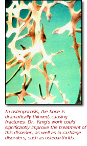 Image showing bone-thinning in osteoporosis