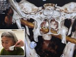 Fu Jinfeng had a 5 inch bamboo stick lodged in her face for eight months without realising until doctors did this scan