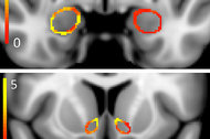 A Harvard-Northwestern study has found differences between the brains of young adult marijuana smokers and those of nonsmokers. In these composite scans, colors represent the differences — in the shape of the amygdala, top, and nucleus accumbens. Yellow indicates areas that are most different, red the least.