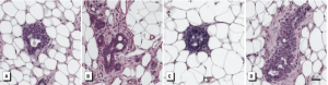 Figure 1. Four photomicrographs of preneoplastic and neoplastic lesions in PND50 mammary glands. Details in legend and Results under Preneoplastic and neoplastic lesions developed in perinatally exposed mammary glands.