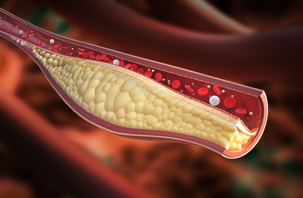 medical graphic of a coronary artery