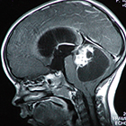 New hope for children with brain tumors