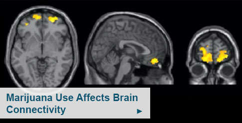 Image of three brain scans