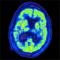 PET scan of a brain