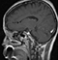 This is a picture of a head CT showing one half of the brain