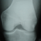 This is a thumbnail image of an x-ray of the knee joint