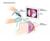 The test developed by NIH and Italian scientists involves the insertion of a rigid fiber-optic rhinoscope into the patient’s nasal cavity. A sterile brush is then inserted alongside the scope to collect olfactory neurons by gently rolling along the mucosa