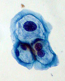 ThinPrep liquid-based Pap. HPV-infected cells with mild dysplasia (LSIL).