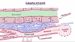 File:Cirrhosis.webm