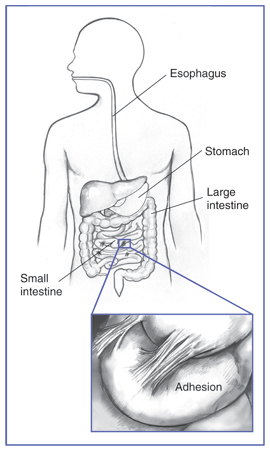 Drawing of the gastrointestinal tract showing the esophagus, stomach, and large intestine. Inset shows abdominal adhesions on the small intestine.