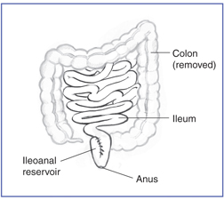 Drawing of the removed colon, and the ileum, ileoanal reservoir, and anus.