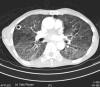 lung ct