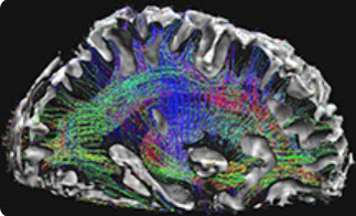 magnetic resonance image of brain