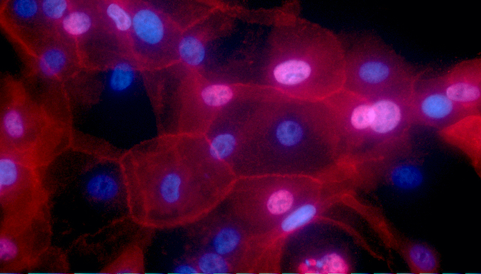 breast cancer cells