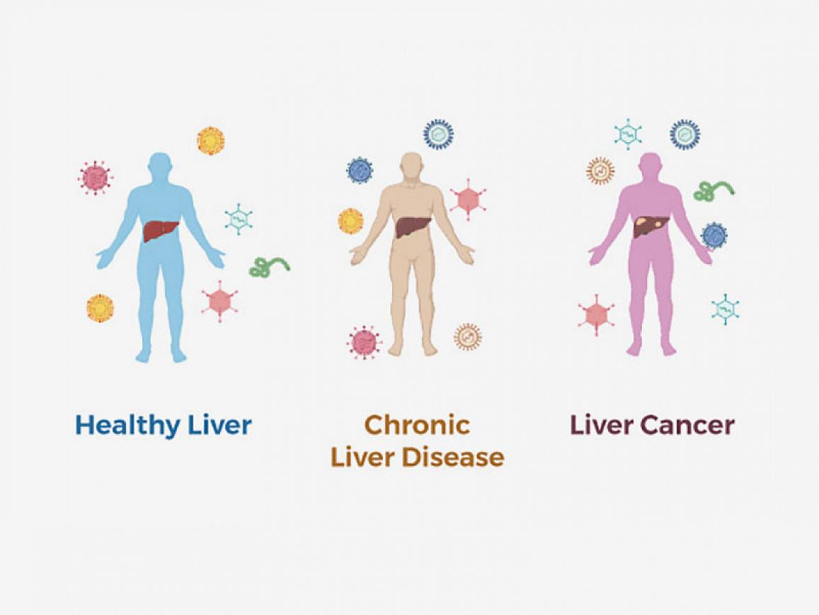 Illustration of different types of liver disease