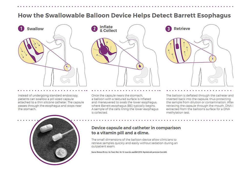 How the swallowable balloon device helps detect Barrett Esophagus.