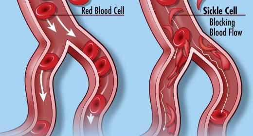 sickle-cell disease