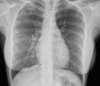 A chest X-ray of active tuberculosis in the right upper lung